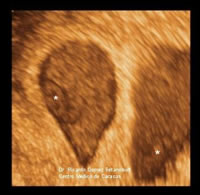 Ultrasound of multiple pregnancy