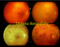Gráfico con evidencia de retinopatía diabética