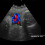 Doppler image of double circular umbilical cord