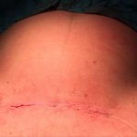 Wound after cesarean section