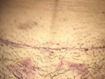 Wound after the removal of the points by caesarean section