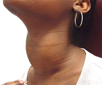 Evidence of hypothyroidism in the form of a goiter