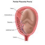 Placenta previa parcial