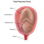 Placenta previa total