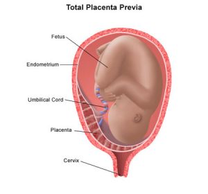 Placenta previa total