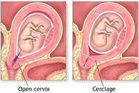 Cerclaje de cuello uterino