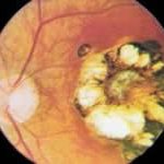 Retinitis due to toxoplasmosis