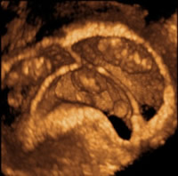Ultrasound of multiple pregnancy