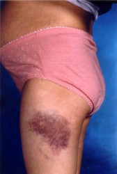 Evidence of violence in a pregnant woman