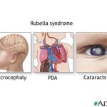 Graph about congenital rubella