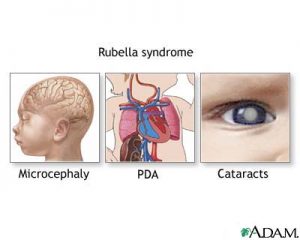 Gráfico sobre la rubéola congénita