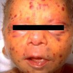 Baby with congenital rubella